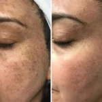 سرم ضدلک قوی ملاپرو ناین لس