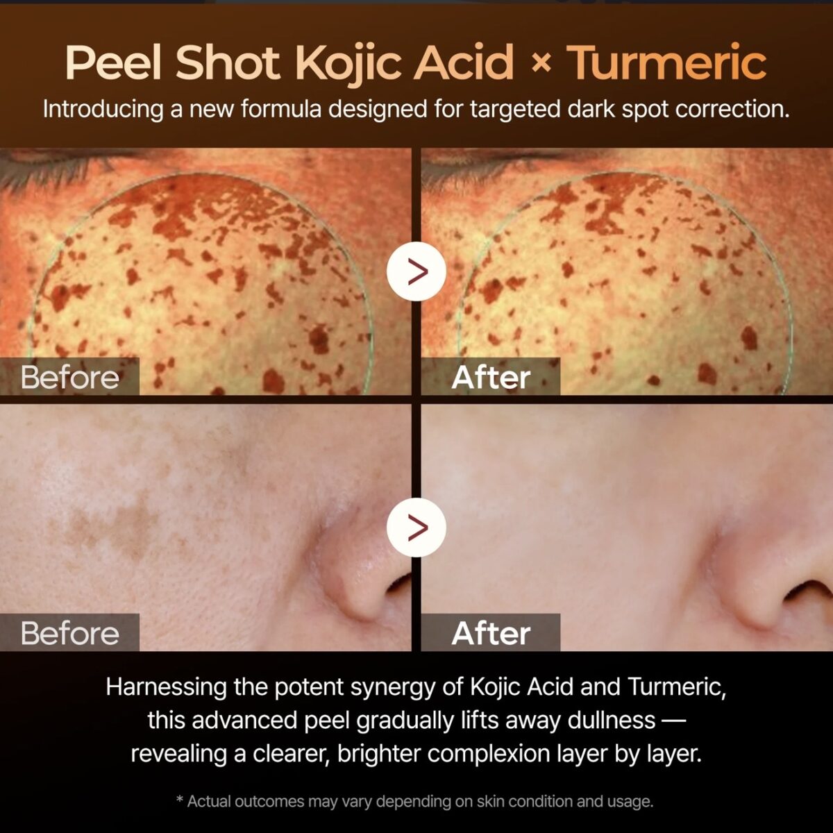 ست پیلینگ شات کوجیک اسید و زردچوبه صورت بدن و پا دکتر ملاکسین - Image 10